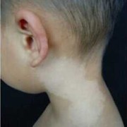 如何防止胎儿长胎记（如何防止胎儿长胎记的方法）