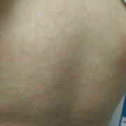 孕期长疹子（孕晚期身上起了很多疹子怎么办，可以抹药吗）