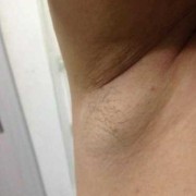 孕期腋下肿大（孕期腋下肿大是怎么回事）