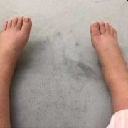孕期小腿酸胀（怀孕了腿肿怎么办）