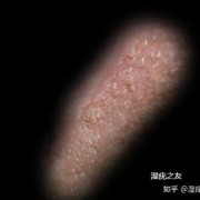 尖锐湿庞胎儿还能要吗（我得了尖锐湿疣，可以要孩子吗）
