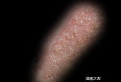 尖锐湿庞胎儿还能要吗（我得了尖锐湿疣，可以要孩子吗）
