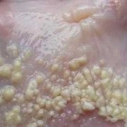 念珠菌能彻底治愈吗,念珠菌是男人传染的吗