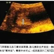 胎儿肛门闭锁超声图像（胎儿肛门闭锁超声图像）