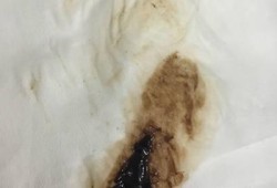 怀孕出血褐色怎么回事,孕期流褐色血对胎儿有影响吗