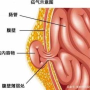 孕期疝气（孕期疝气需要注意什么）