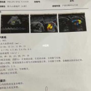 胎儿心脏卵圆孔正常值（胎儿心脏卵圆孔正常值是多少?）