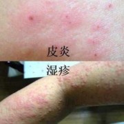 孕妇得湿疹怎么治,怀孕期间起湿疹怎么办 会不会影响宝宝