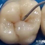 孕期蛀牙掉了（孕期蛀牙掉了一半,可以填补吗）