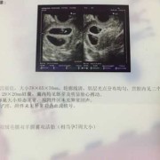 胎儿胎囊会萎缩吗（孕囊大胎芽小正常吗）