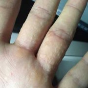 孕期手上起湿疹怎么办（手指上长像湿疹，透明小疹子，能用醋泡手吗）