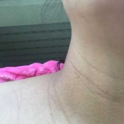 孕期脖子变黑长纹（孕妇脖子变黑是怎么回事呢？正常的吗）