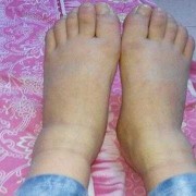 孕妇六个月脚肿是什么原因？这是什么情况啊,孕期脚踝肿是什么原因引起的