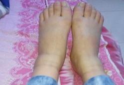 孕妇六个月脚肿是什么原因？这是什么情况啊,孕期脚踝肿是什么原因引起的