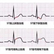 孕妇心电图st一t压低能生孩子吗,孕期心电图st改变要紧吗