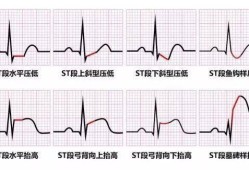 孕妇心电图st一t压低能生孩子吗,孕期心电图st改变要紧吗