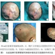 胎儿血肿（新生儿头皮血肿会引起黄疸高吗）