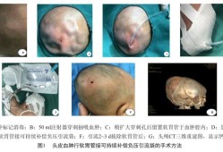 胎儿血肿（新生儿头皮血肿会引起黄疸高吗）