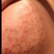 怀孕后胸痒怎么回事,孕期胸很痒怎么回事