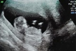 12周胎儿头臀径标准,怀孕12周胎儿会动吗正常吗