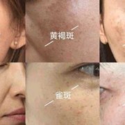 怀孕期间脸上长斑是什么原因（怀孕期间脸上长斑是什么原因）