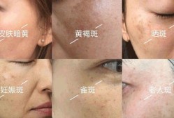 怀孕期间脸上长斑是什么原因（怀孕期间脸上长斑是什么原因）