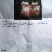 孕囊积液跟拉肚子有关吗,胎儿肠管积液是什么意思