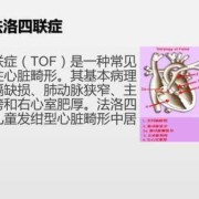 胎儿法洛四联症（胎儿法洛四联症能要吗）
