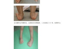 三岁孩子脚内翻是什么原因,胎儿足内翻的原因有哪些