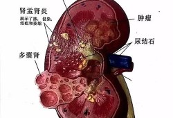 胎儿双肾大小不一致左肾3.4*2.0cm，右肾2.7*1.6cm有影响吗,胎儿双肾偏大是畸形吗怎么治疗