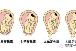 胎儿臀先露（一岁以内的宝宝要不要露屁股）