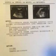 胎儿脾超声（肝胆胰脾肾彩超需要空腹吗）
