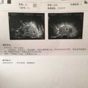 妊娠空囊是怎么回事,胎儿是空囊是什么意思