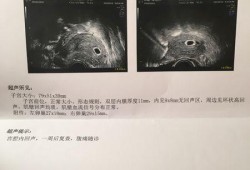 妊娠空囊是怎么回事,胎儿是空囊是什么意思