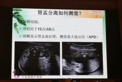 胎儿左右肾盂分离（胎儿左右肾盂分离是什么意思）