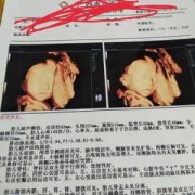 四维生育险能报多少,胎儿四维多少钱照