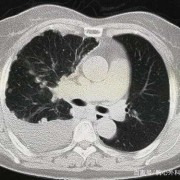 两肺感染性病变TB可能大右侧胸腔积液是什么病,胎儿右侧胸腔积液是怎么造成的