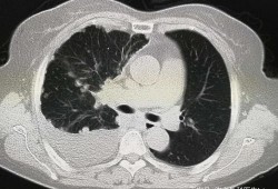 两肺感染性病变TB可能大右侧胸腔积液是什么病,胎儿右侧胸腔积液是怎么造成的