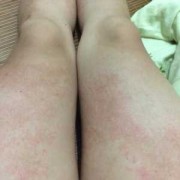 孕妇得皮炎影响胎儿吗（孕妇得皮炎影响胎儿吗）