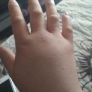 孕期手肿了（怀孕32周手指肿了，怎么回事）