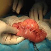 胎儿肠系膜囊肿（胎儿肠系膜囊肿会被吸收吗）