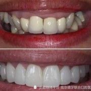 烤瓷牙都有哪些种,孕期烤瓷牙掉了可以粘么