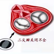 肺动脉瓣轻度返流与二、三尖瓣轻度返流，严重吗？如何治疗,胎儿肺动脉瓣少量返流伴迷走右锁骨下动脉
