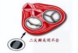 肺动脉瓣轻度返流与二、三尖瓣轻度返流，严重吗？如何治疗,胎儿肺动脉瓣少量返流伴迷走右锁骨下动脉