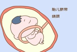 胎儿脐带绕颈一周是什么意思（胎儿脐带绕颈一周怎么才能转过来）