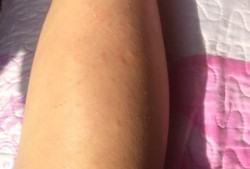孕期身上红疙瘩（孕妇腿上起红疙瘩还很痒要怎么办）