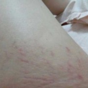 孕期有血丝（孕期有血丝正常吗）