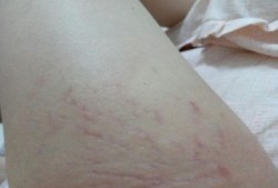 孕期有血丝（孕期有血丝正常吗）