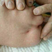 胎儿隐性脊柱裂能要吗（儿童隐性的脊柱裂什么表现）