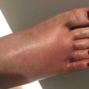 孕期脚气（孕妇得脚气怎么办）